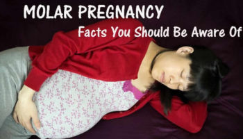 molar pregnancy