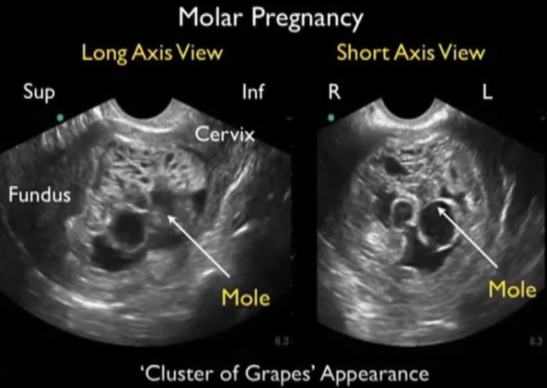 clinical presentation in molar pregnancy