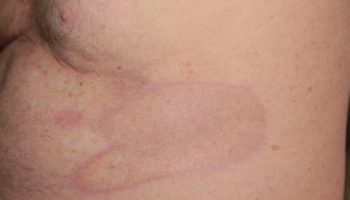 morphea skin