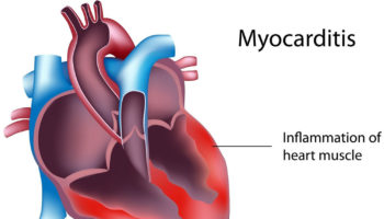myocarditis
