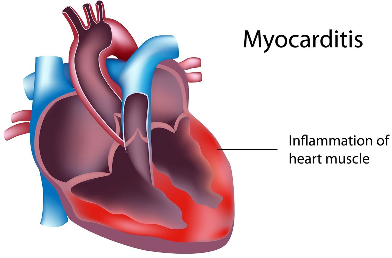 Myocarditis Causes, Symptoms, Recovery Time, Diagnosis & Treatment