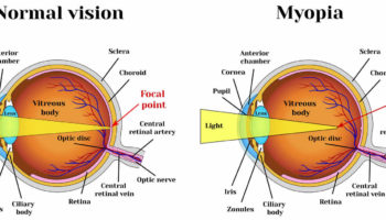 myopia