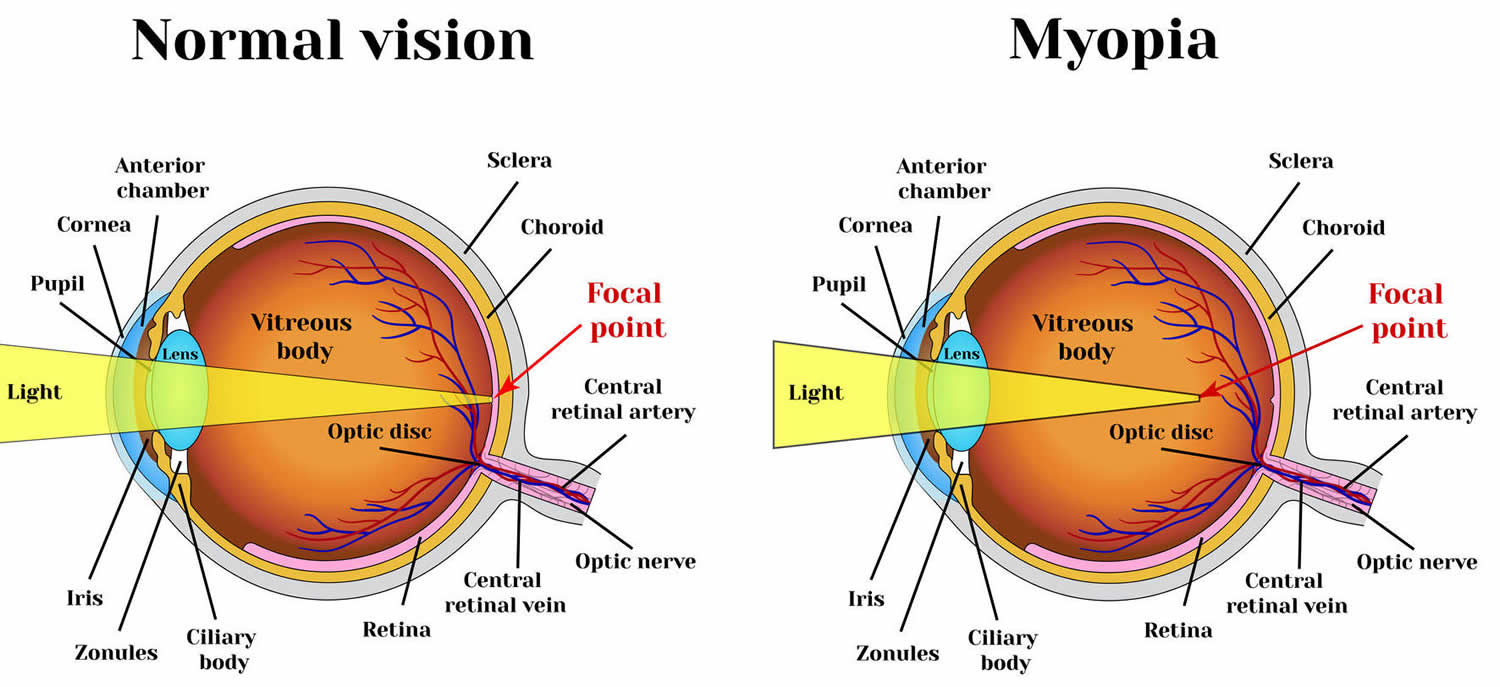 myopia - nearsightedness
