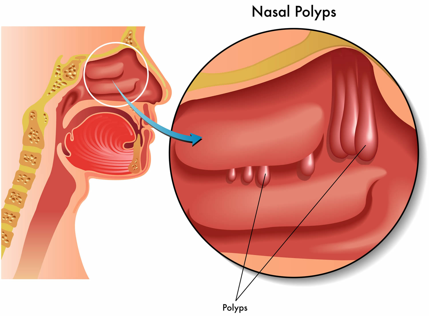 Can Nasal Polyps Spread To Throat