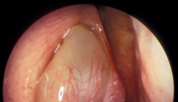 nasal polyps