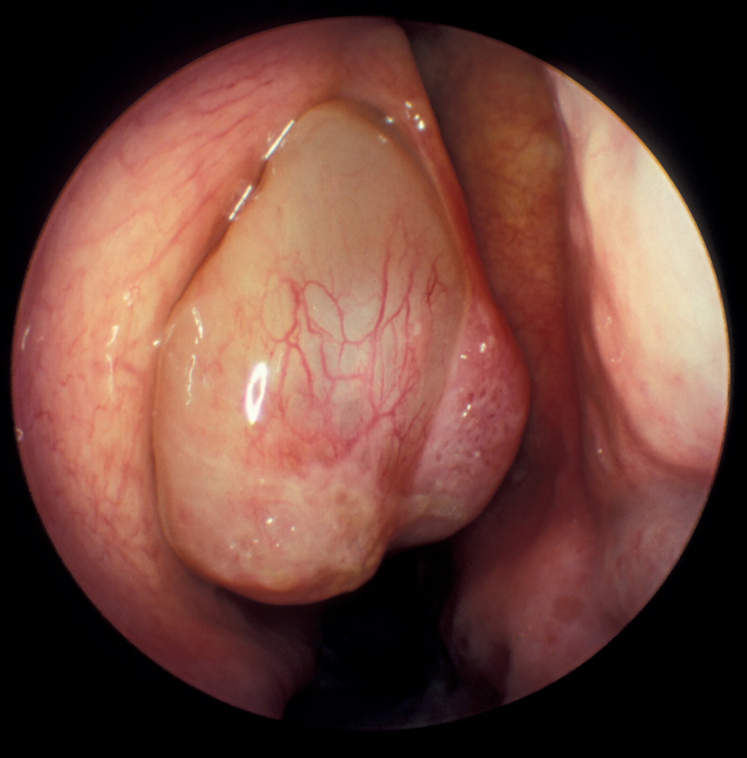 nasal polyps pictures