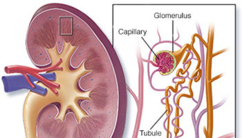 nephrotic syndrome