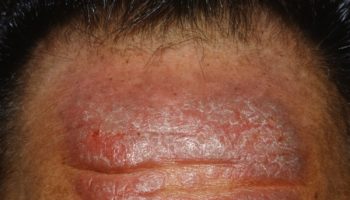 neurodermatitis_face