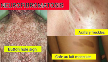 neurofibromatosis