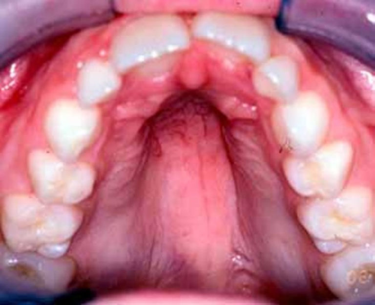 Noonan Syndrome - Causes, Symptoms, Prognosis, Treatment