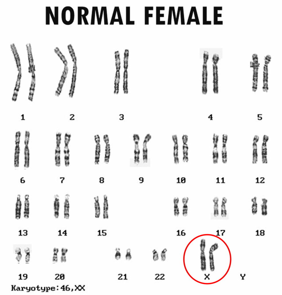 turner-syndrome-causes-symptoms-life-expectancy-treatment