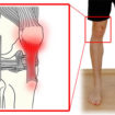 patellar_tendinitis