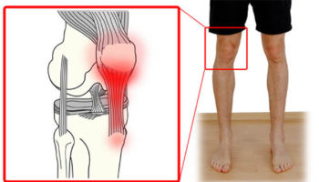 patellar_tendinitis