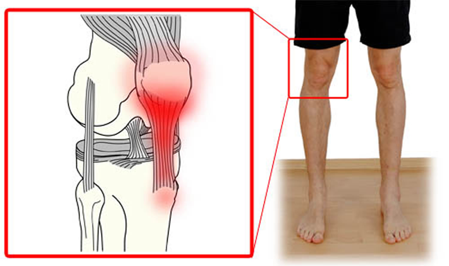 Можно ли простудить ногу. Тендиноз сухожилия надколенника. Тендинопатия надколенника. Тендинит сухожилия подколенной мышцы. Тендовагинит коленного сустава.