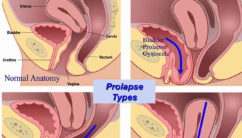 pelvic organ prolapse