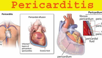 pericarditis