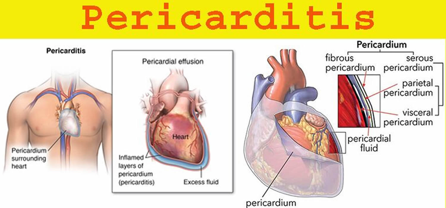 pericarditis-causes-symptoms-prognosis-diagnosis-treatment