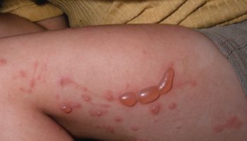 poison ivy rash 2