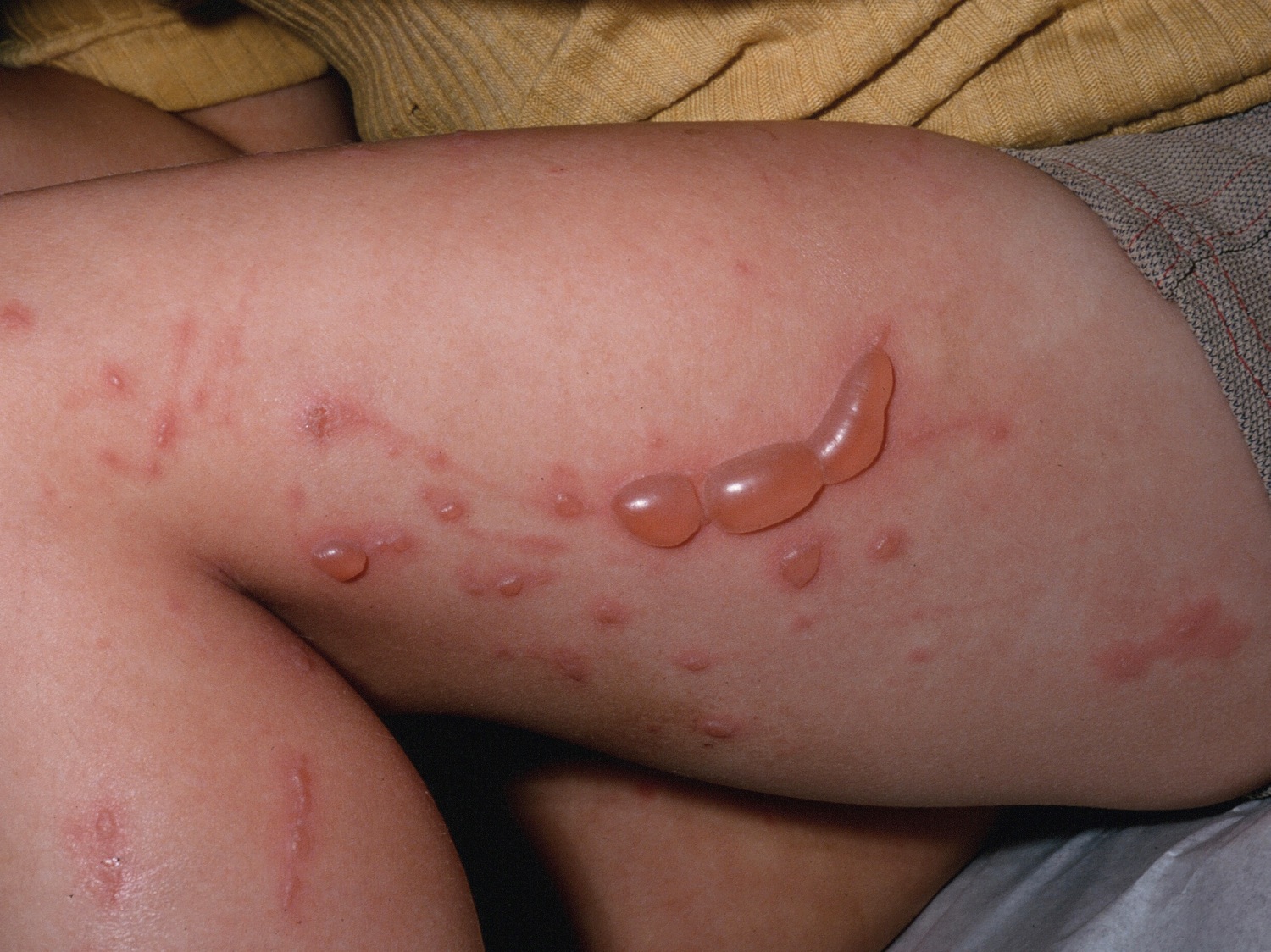 Poison Ivy Rash Causes How To Identify Poison Ivy Rash Treatment,Steaming Green Beans In Pressure Cooker