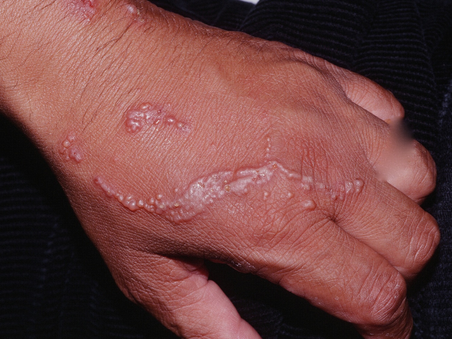 Poison Ivy Rash Causes How To Identify Poison Ivy Rash And Treatment