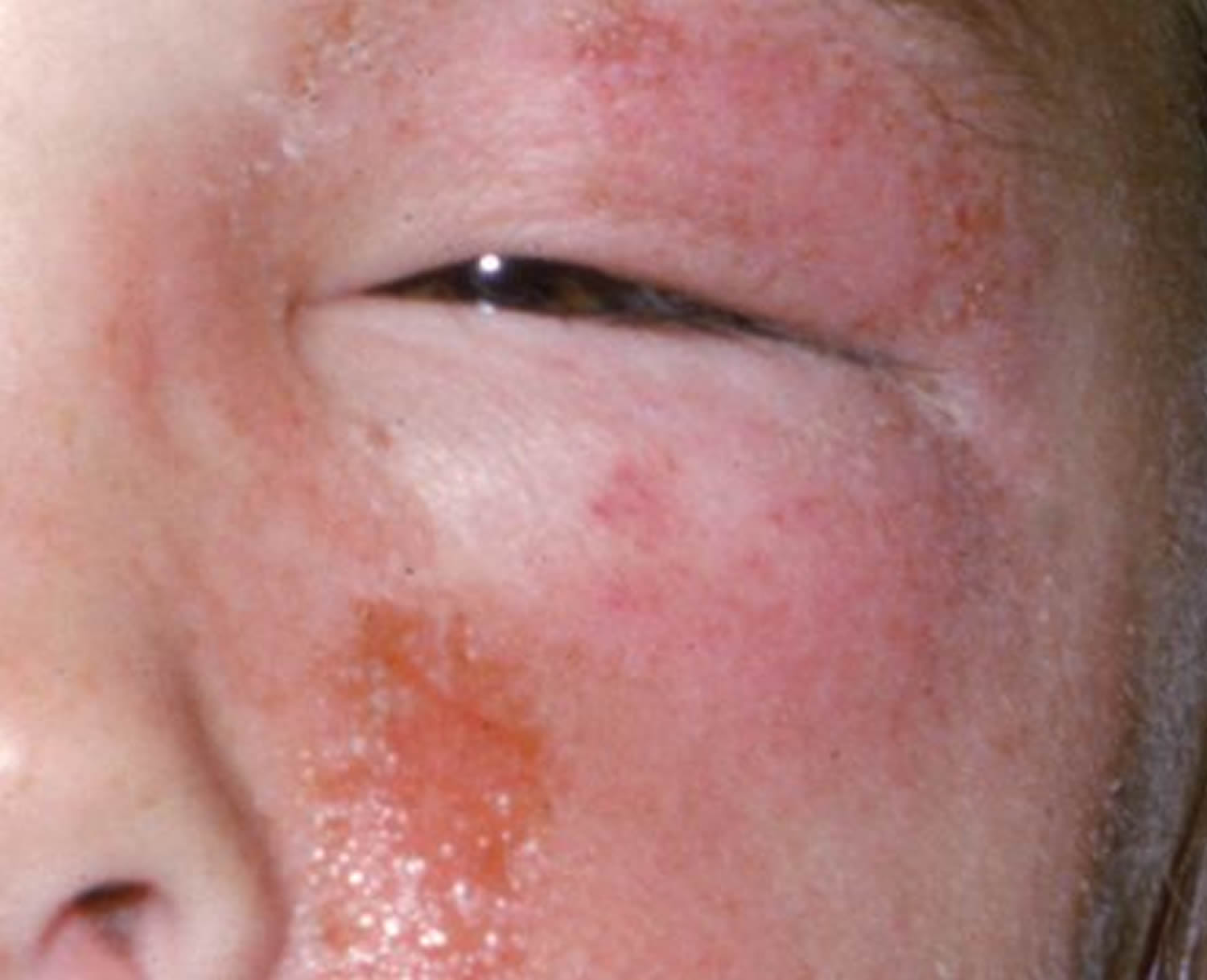 What Looks Like A Poison Ivy Rash