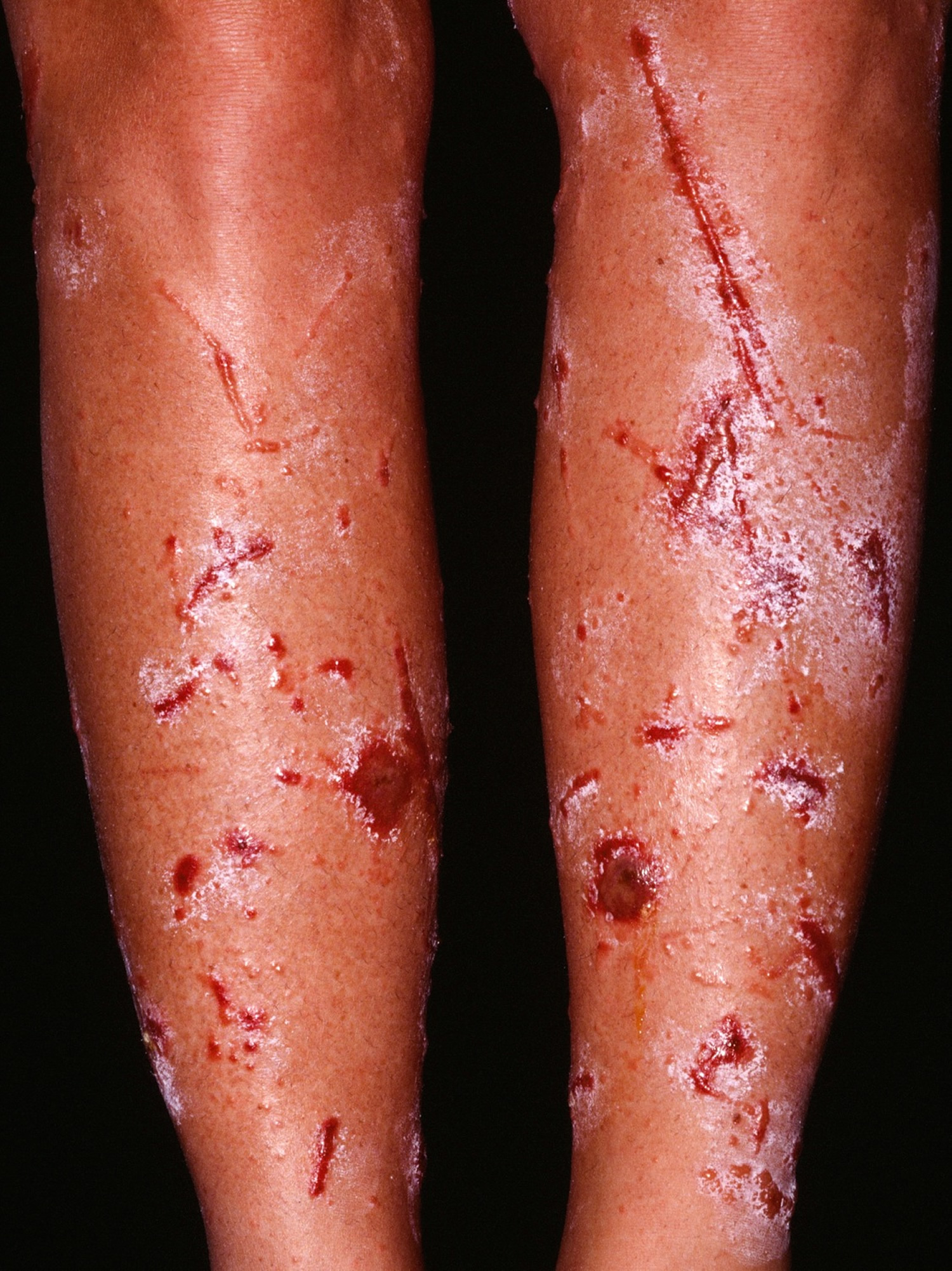 poison-ivy-rash-legs.jpg