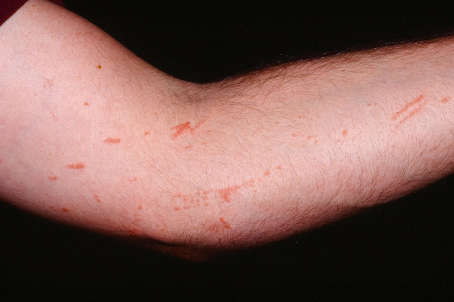 Poison Ivy Pictures On Skin ~ Poison Ivy Picture (hardin Md Super Site ...