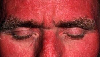 polymorphic light eruption face