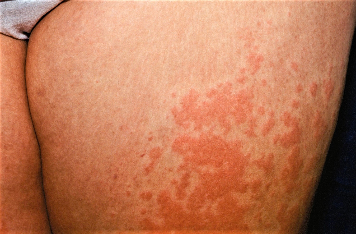 Polymorphic Light Eruption Causes Rash Treatment