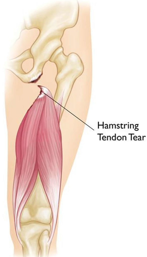 Hamstring Injury Causes Symptoms Recovery Time And Treatment