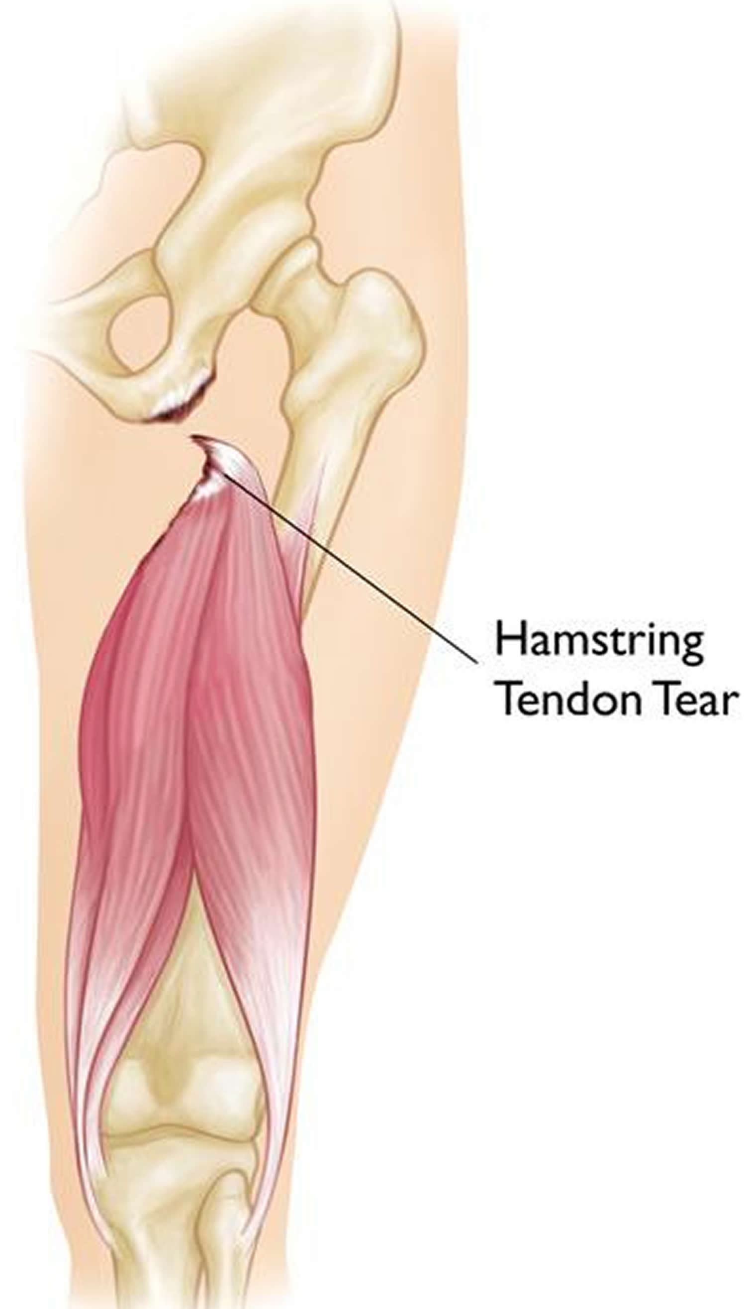 Hamstrings мышца