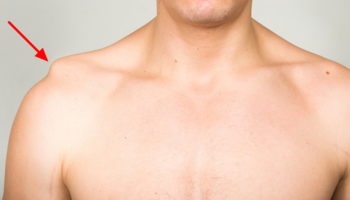 separated shoulder