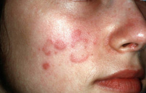 Polymorphic Light Eruption - Causes, Rash, Treatment