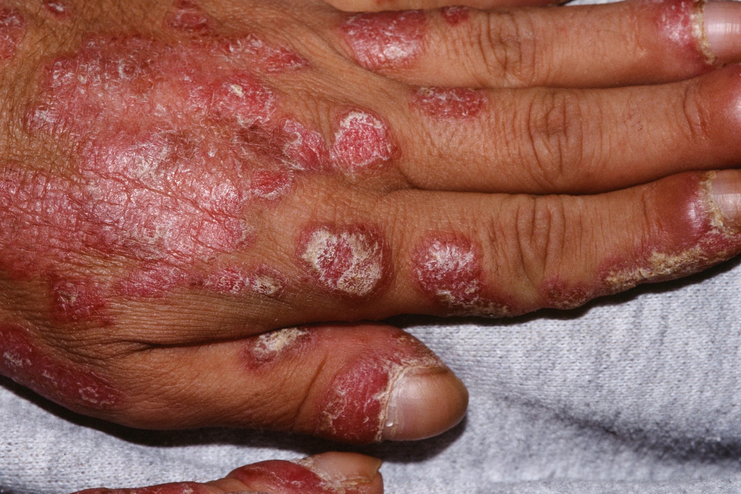 Polymorphic Light Eruption Causes, Rash, Treatment