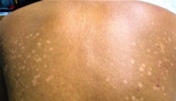 tinea versicolor