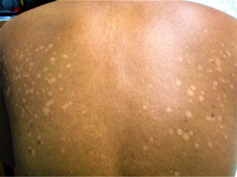 Tinea Versicolor Causes, Signs, Symptoms, Treatment & Remedies