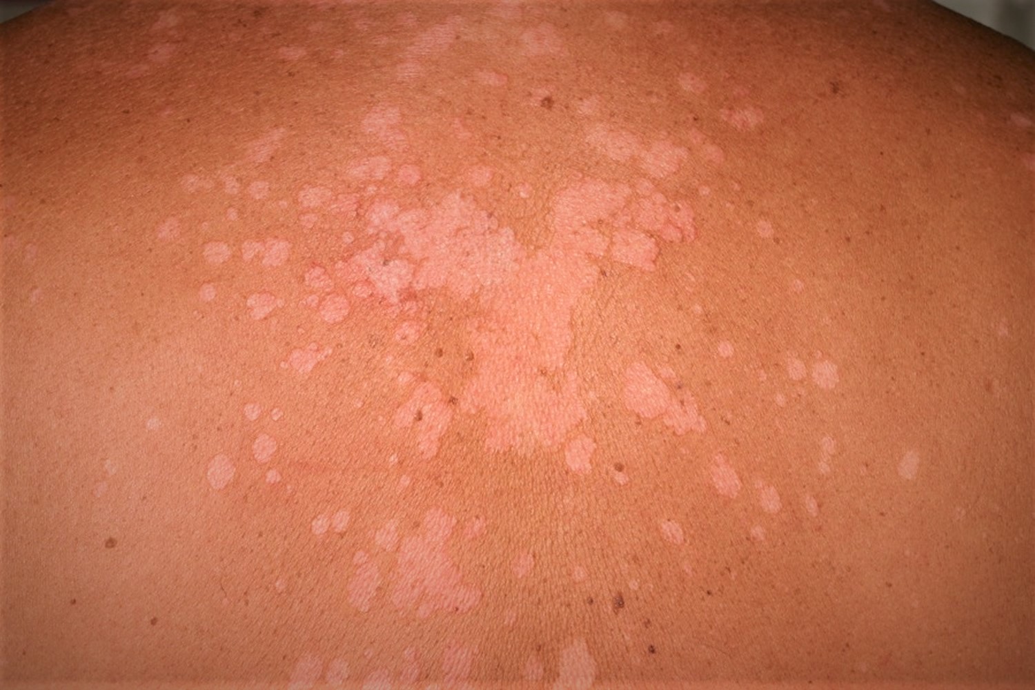 Can Tinea Spread From Person To Person