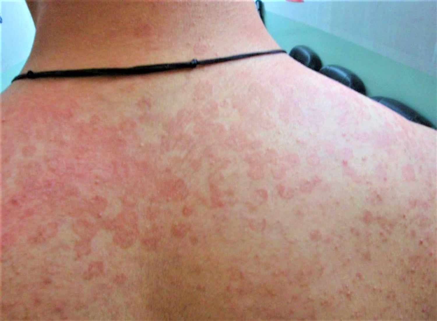 Tinea Versicolor Image