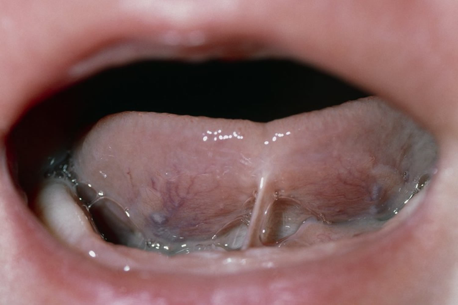 ankyloglossia