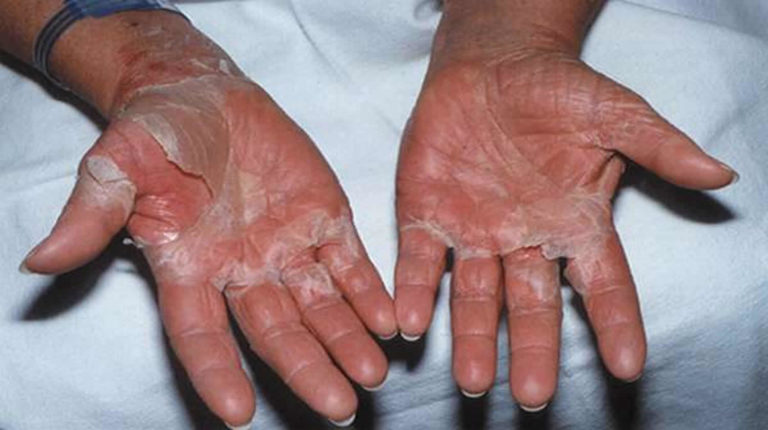 toxic-shock-syndrome-causes-signs-symptoms-treatment