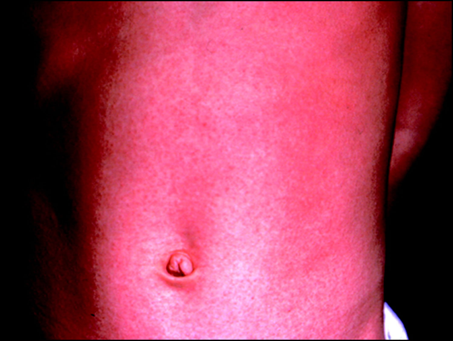 toxic shock syndrome skin rash