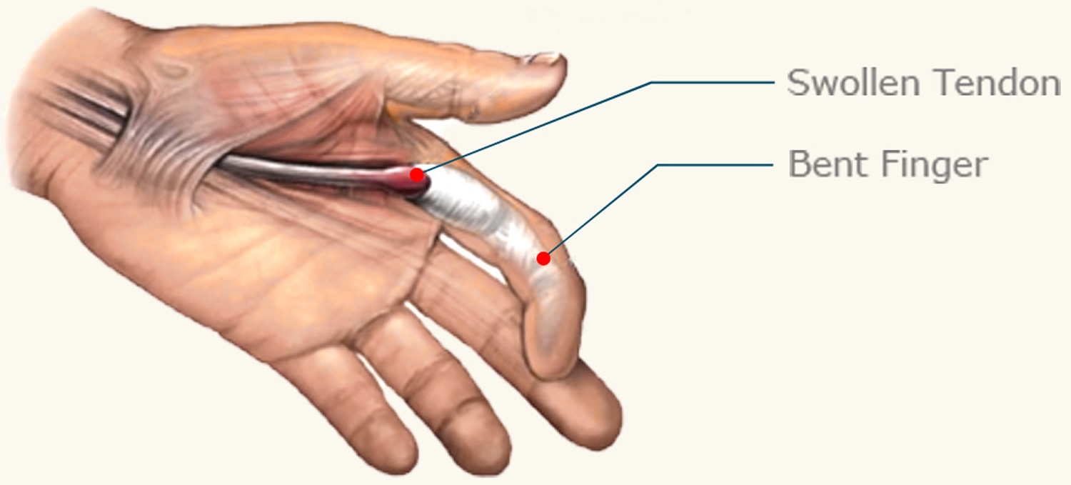 Trigger vitamins finger for Trigger finger: