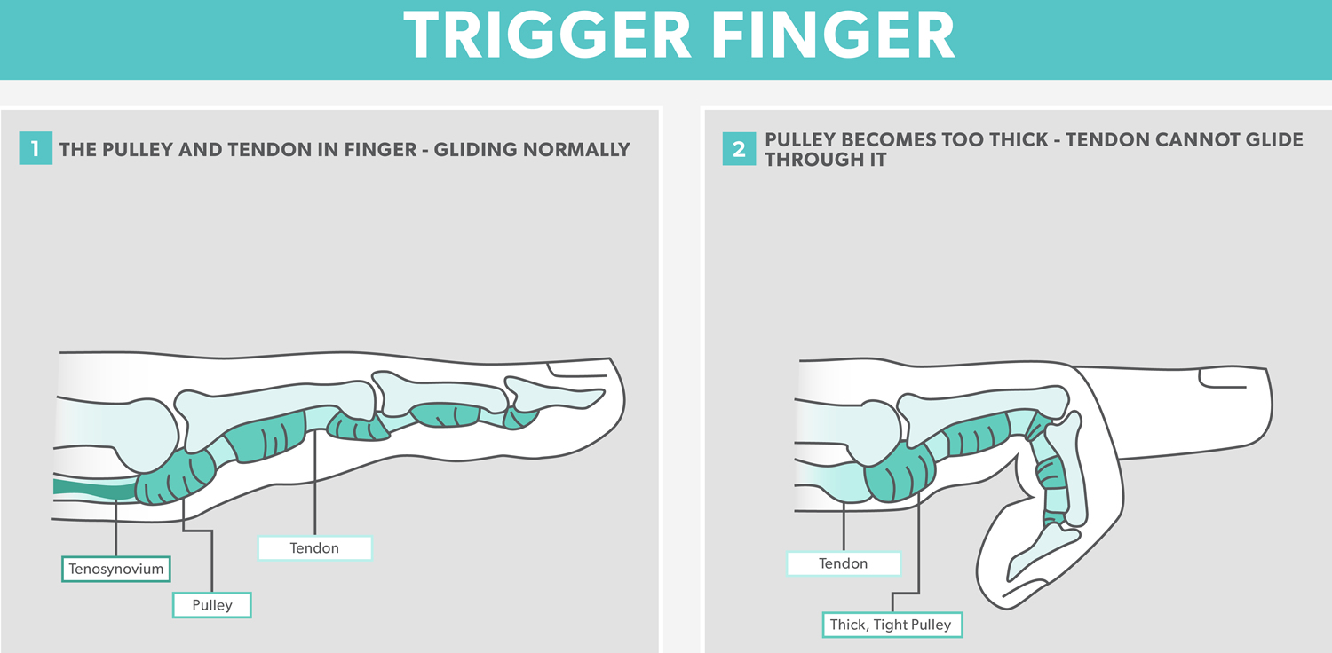 Trigger finger orthobullets