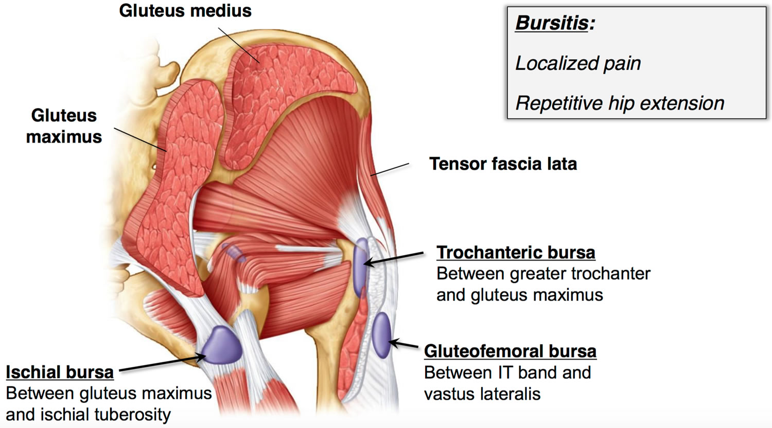 trochanteric bursitis