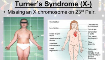 turner syndrome