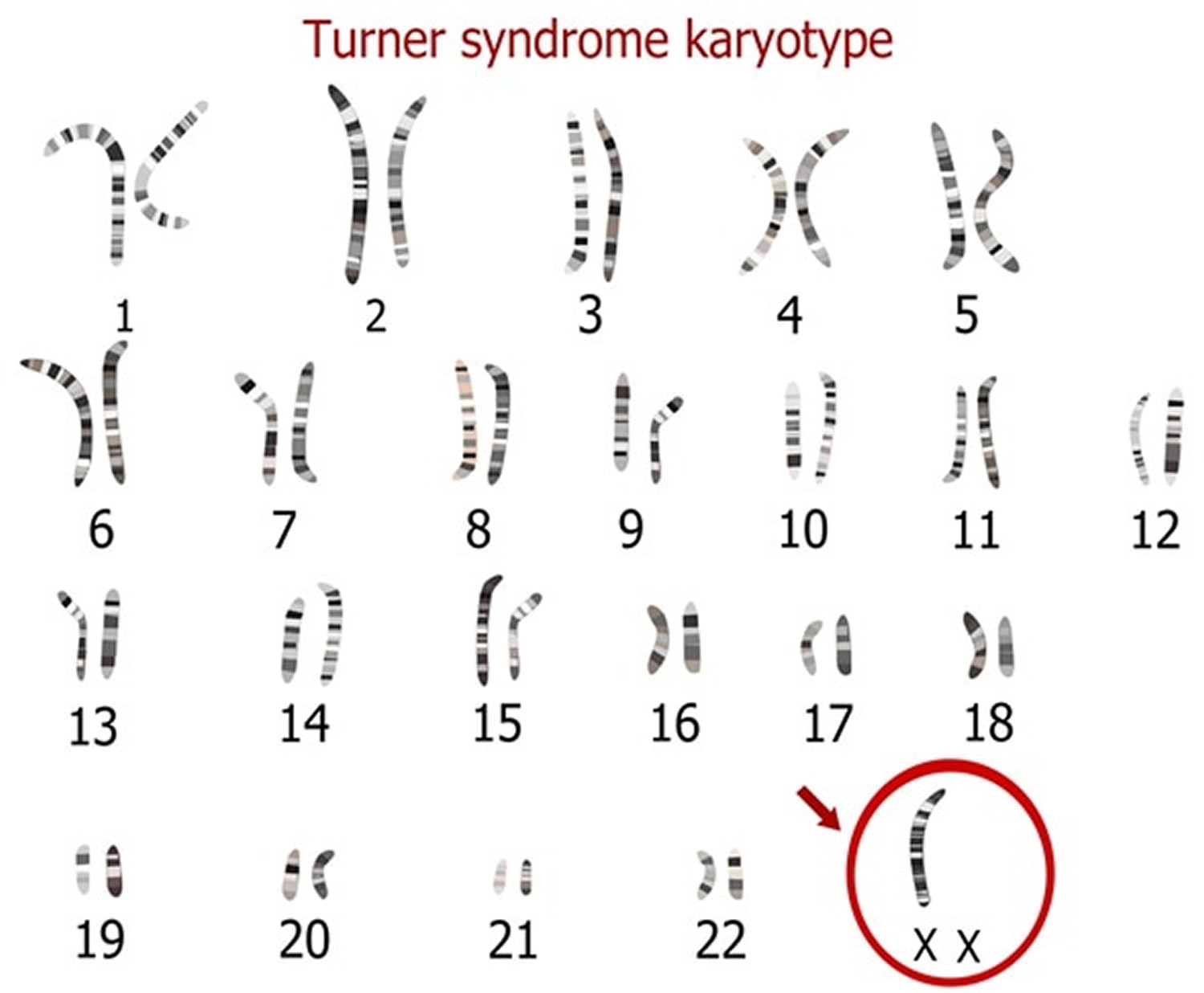 Sindrome De Turner Cromossomos Sololearn