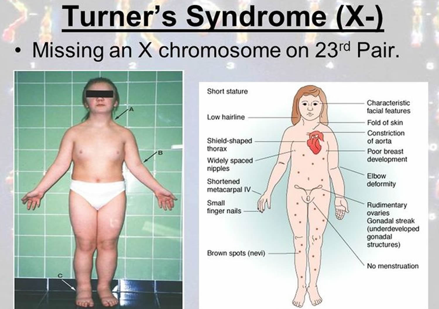 Turner sindrom Sindromul Turner
