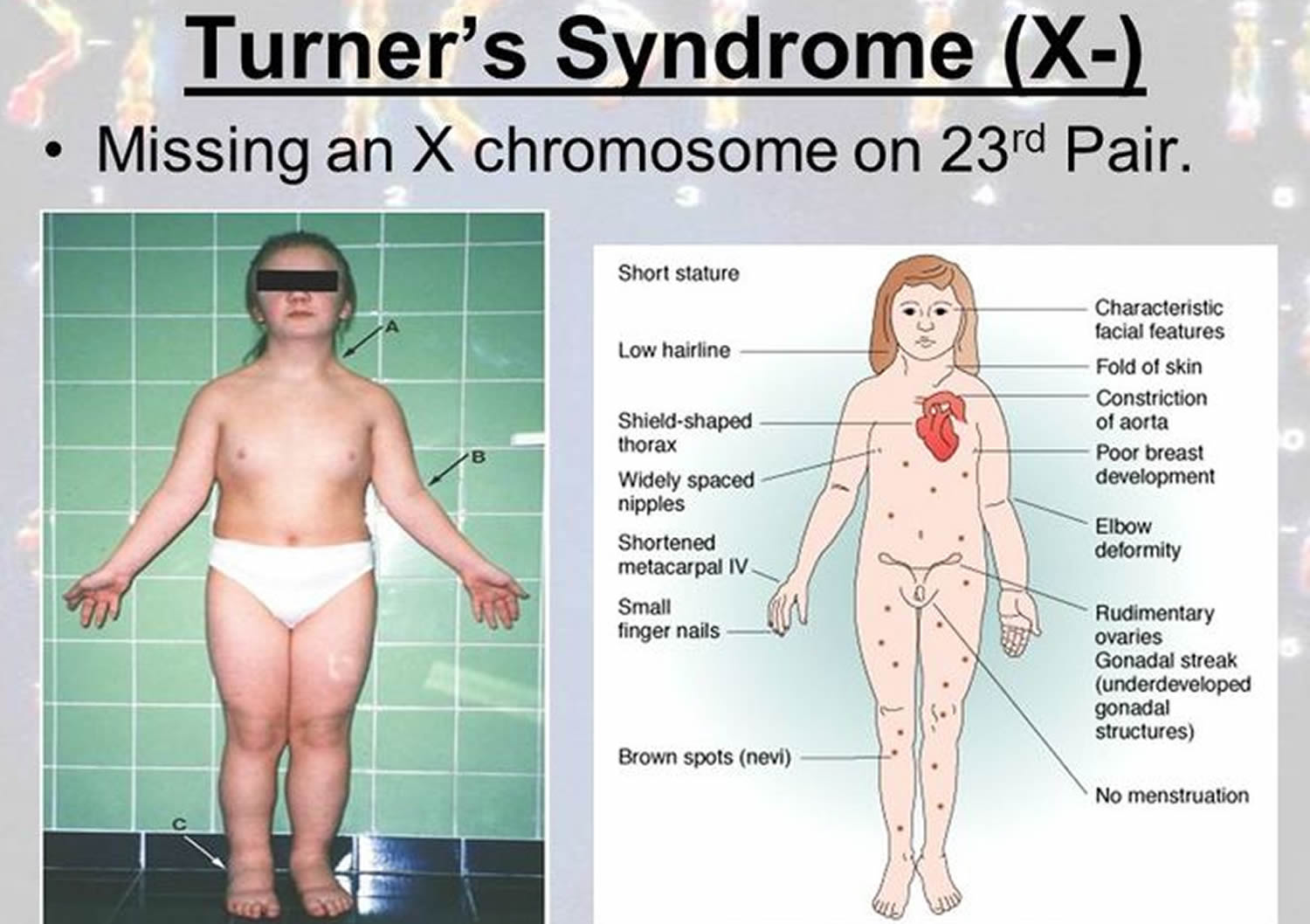 monosomy turner syndrome