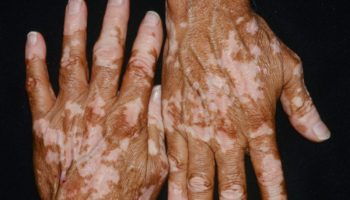 vitiligo skin