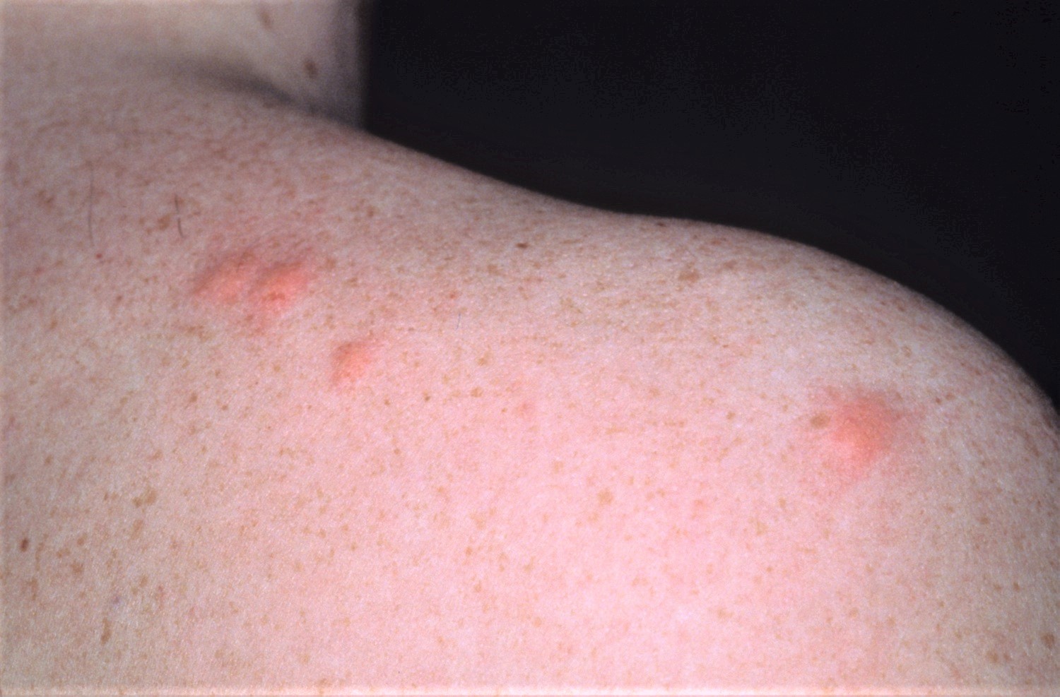 What Are Mozzie Bites at Laura Parrish blog